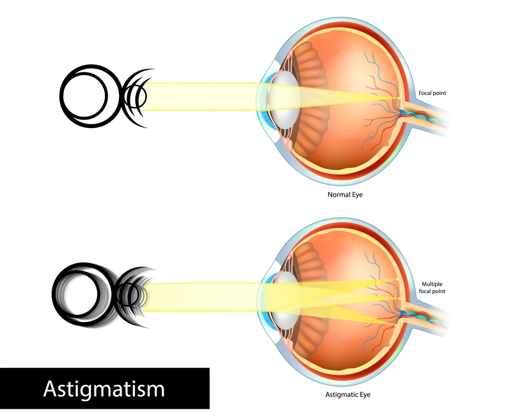 Astigmatism Vision