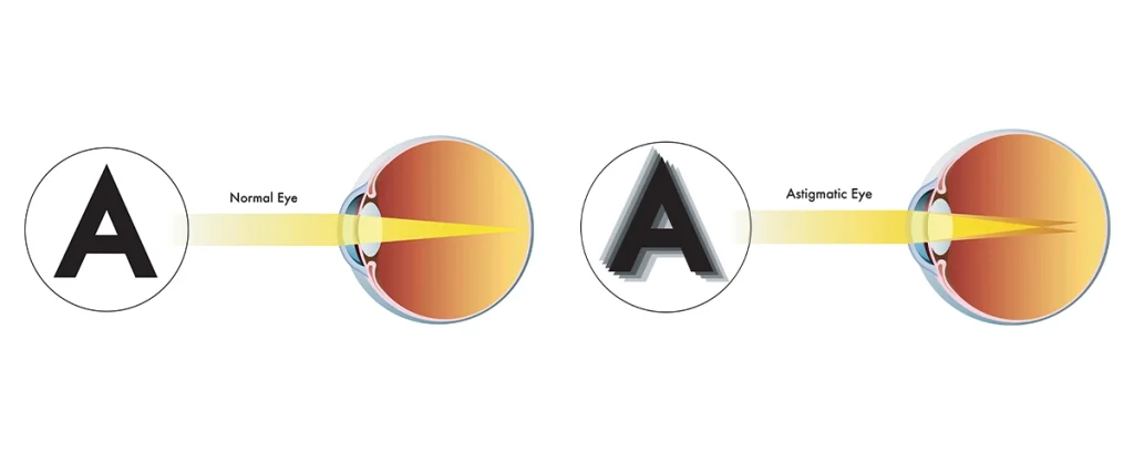 Comparison diagram showing how a normal eye sees a clear letter A while an astigmatic eye sees a blurred, distorted version due to improper light focus
