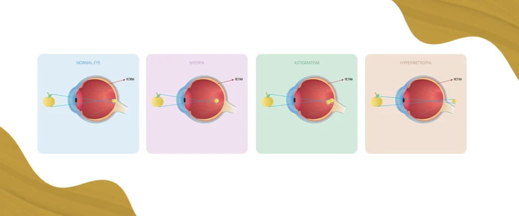 Diagram comparing a normal eye with myopia, astigmatism, and hypermetropia, showing how each condition affects light focus on the retina
