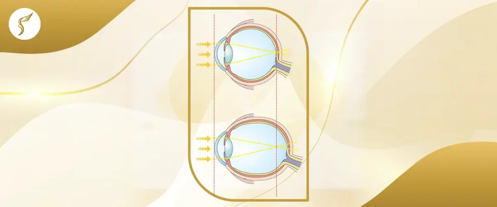 Medical diagram comparing normal vision and refractive error in the human eye at Shinagawa Lasik & Aesthetics in the Philippines