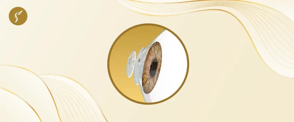 3D medical illustration of human eye with corneal flap during LASIK surgery at Shinagawa Lasik & Aesthetics in the Philippines