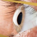 Close-up of a human eye with visible corneal bulging, illustrating signs of keratoconus, with Shinagawa branding design.