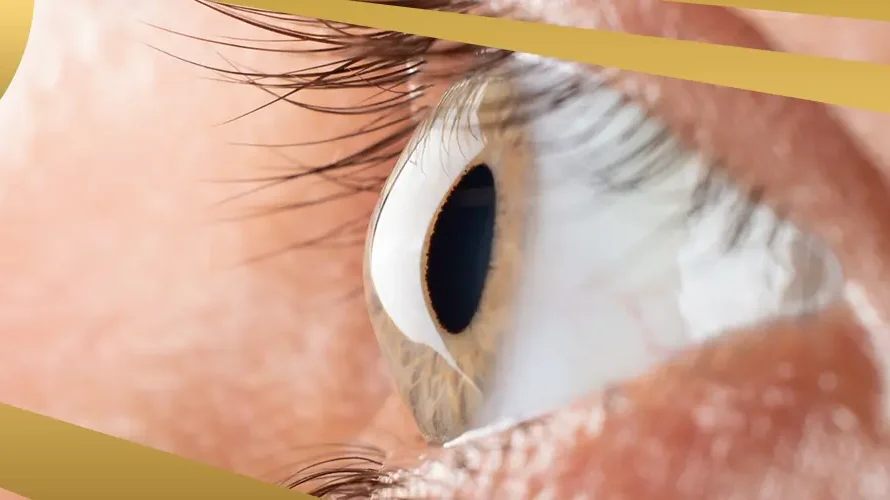 Close-up of a human eye with visible corneal bulging, illustrating signs of keratoconus, with Shinagawa branding design.