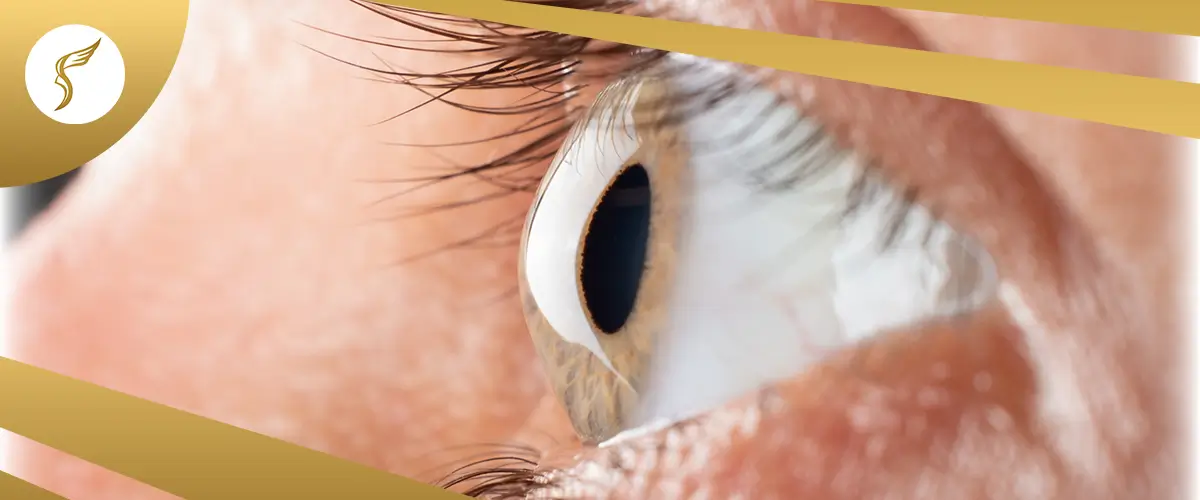 Close-up of a human eye with visible corneal bulging, illustrating signs of keratoconus, with Shinagawa branding design.