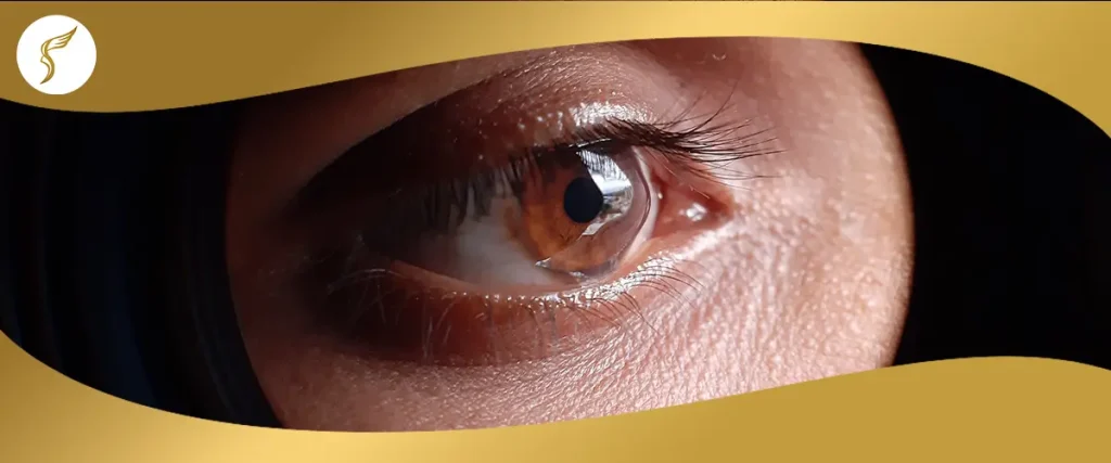 Close-up image of a brown eye with visible corneal bulging, showing early signs of keratoconus progression