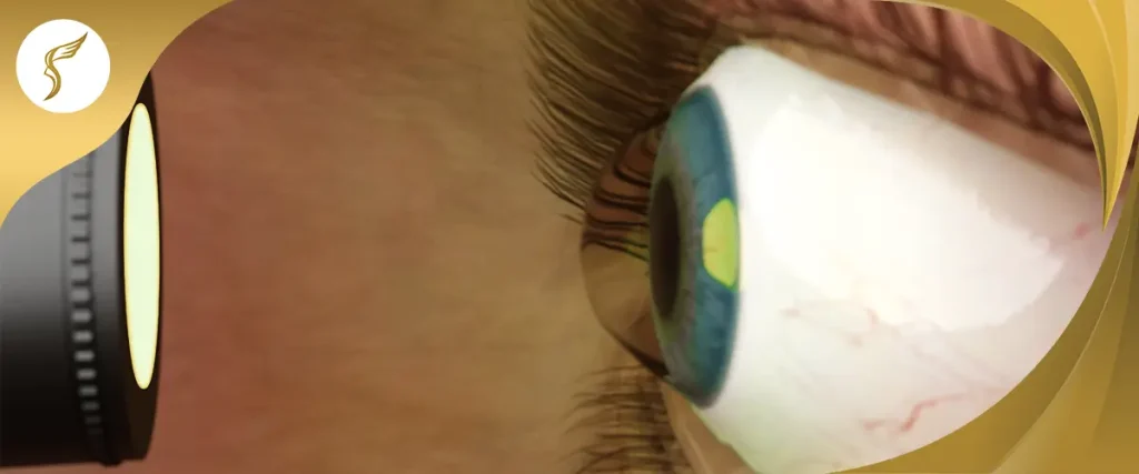 Close-up 3D illustration of an eye with corneal bulging, showing symptoms of keratoconus under examination light