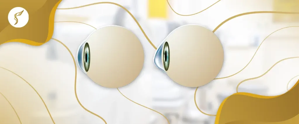 Medical illustration comparing two human eyes, showing differences in corneal shape, highlighting eye condition or vision problem