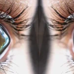 Close-up of human eyes with visible corneal irregularities, illustrating keratoconus condition at Shinagawa Lasik & Aesthetics