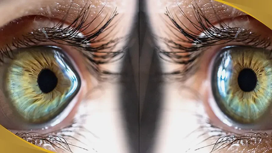 Close-up of human eyes with visible corneal irregularities, illustrating keratoconus condition at Shinagawa Lasik & Aesthetics