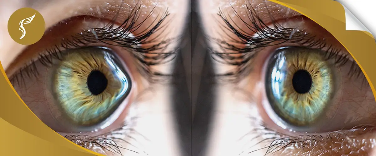 Close-up of human eyes with visible corneal irregularities, illustrating keratoconus condition at Shinagawa Lasik & Aesthetics