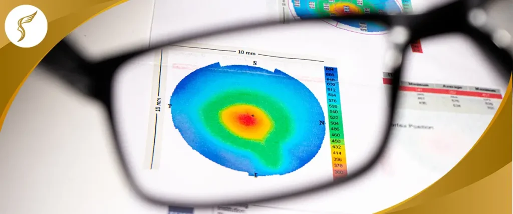Corneal topography map viewed through eyeglasses, illustrating irregular corneal shape and vision distortion caused by keratoconus