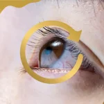 Close-up of an eye showing visible corneal bulging, a common sign of keratoconus and irregular corneal curvature