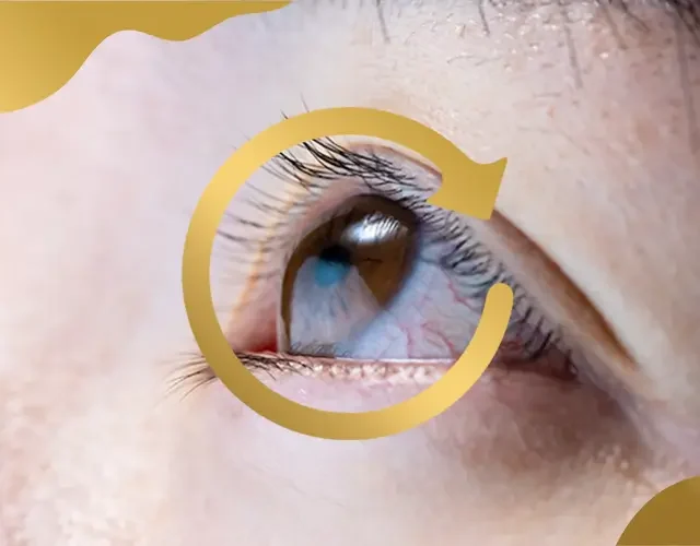 Close-up of an eye showing visible corneal bulging, a common sign of keratoconus and irregular corneal curvature