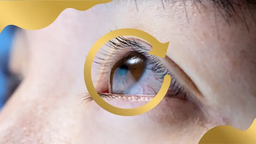 Close-up of an eye showing visible corneal bulging, a common sign of keratoconus and irregular corneal curvature