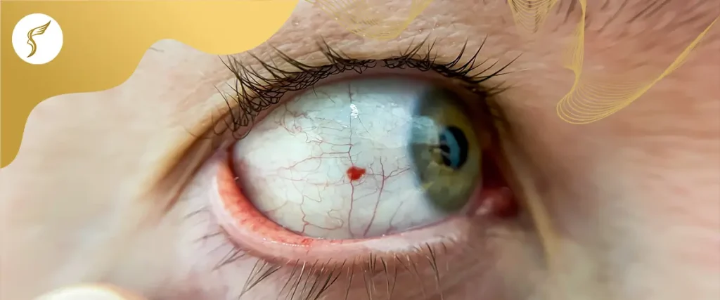 Close-up of a human eye with a subconjunctival hemorrhage, showing a red blood spot on the white of the eye and visible blood vessels.